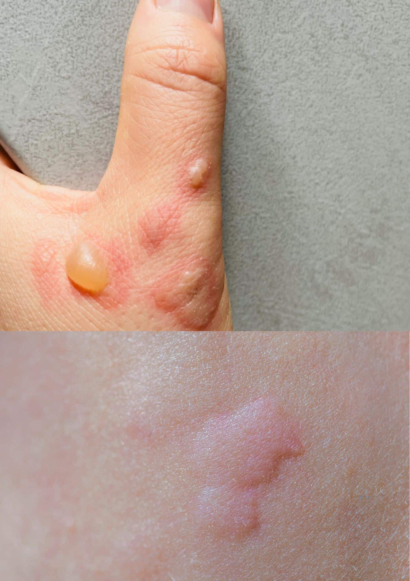 A person hand with blister and skin rashes