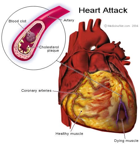 Heart attack anatomy