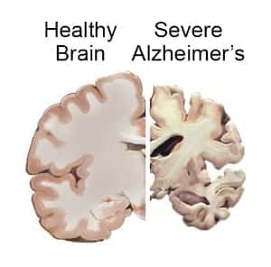 Alzheimers