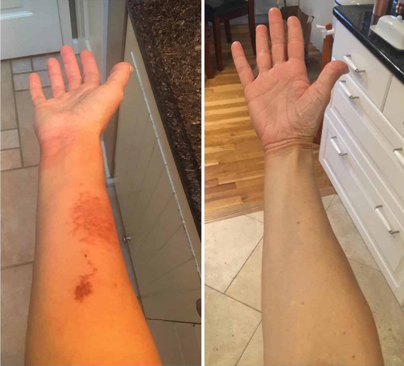 Before and after results of Skin Infection